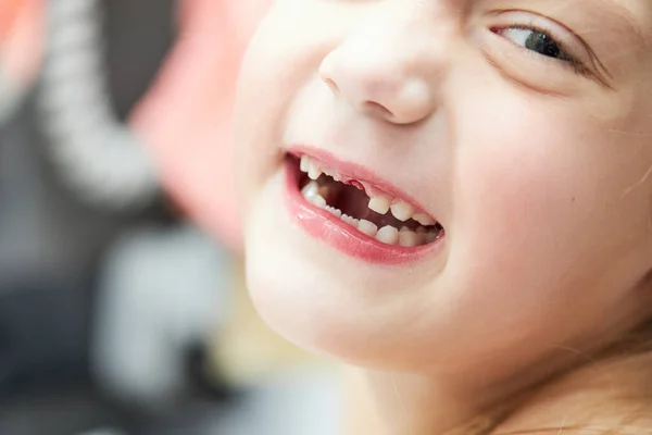 Uma Menina Perdeu Dente Leite Dente Temporário Perdido Conceito Higiene — Fotografia de Stock