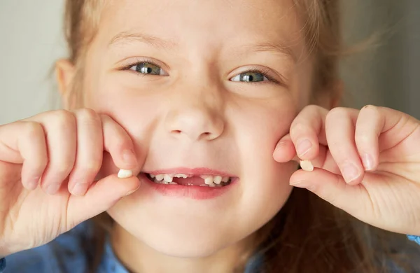 Criança Sem Dentes Menina Bonito Sorri Amplamente Primeiro Dente Leite — Fotografia de Stock