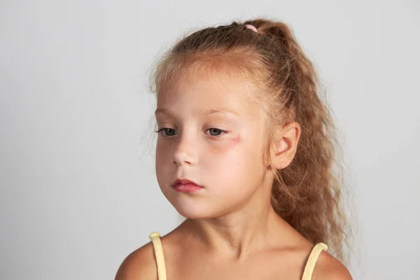 Abrasion Face Girl Child Wound Eye Close Concept Treatment Childhood — Stock Photo, Image