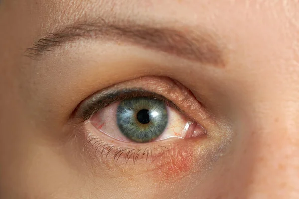 Peeling Swelling Eyelid Human Eye — Fotografia de Stock