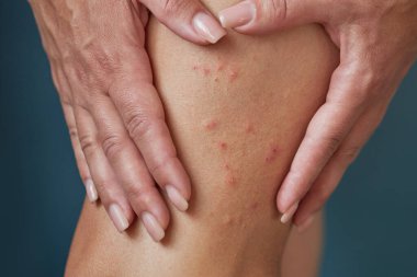 Bir kadının bacağında böcek ısırığı izleri var..