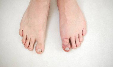 Fractured toe. Broken big toe