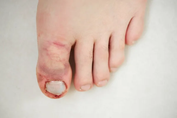 Fractured Toe Broken Big Toe — Stock Photo, Image