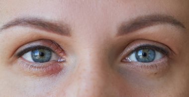 Peeling and swelling on the eyelid of the human eye.