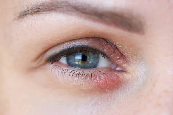 Peeling Swelling Eyelid Human Eye — Stock Photo, Image