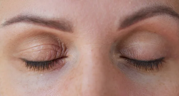 Peeling and swelling on the eyelid of the human eye.