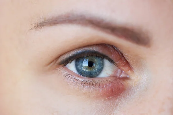 Peeling Swelling Eyelid Human Eye — Stock Photo, Image