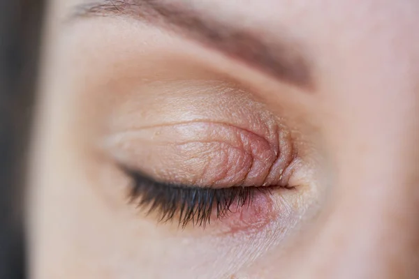 Peeling and swelling on the eyelid of the human eye.