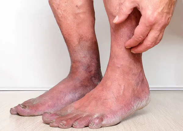 People suffering from varicose veins often come to the phlebologist too late - at the moment when visible signs have already appeared on the legs: swelling, changes in the structure of the skin, ulcers, swollen veins, \