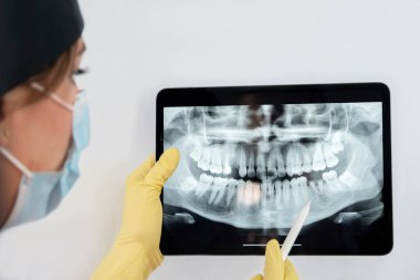 female dentist shows the patient his x-ray, the x-ray is of an old young male female and explains the procedure and treatment he will receive on his teeth, the x-ray shows the damage to the teeth.