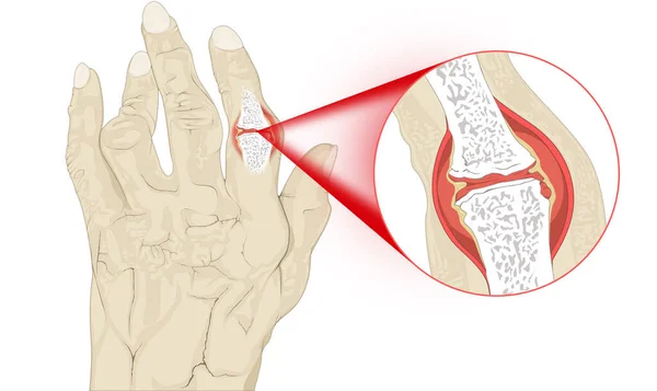 Senior Hand Met Reumatoïde Artritis Zoom — Stockfoto