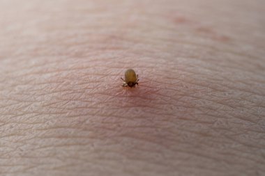İnsan derisiüzerinde kene Makro fotoğraf emme. Ixodes ricinus. Pembe tahriş olmuş epidermisin içine ısırılan şişmiş parazit. Küçük kırmızı damlalar. Tehlikeli böcek akarı. Ensefalit, Lyme hastalığı enfeksiyonu.