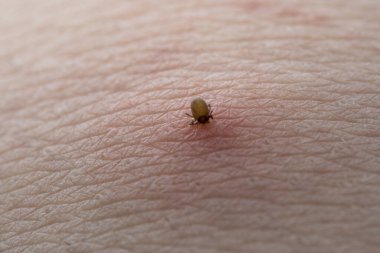 İnsan derisiüzerinde kene Makro fotoğraf emme. Ixodes ricinus. Pembe tahriş olmuş epidermisin içine ısırılan şişmiş parazit. Küçük kırmızı damlalar. Tehlikeli böcek akarı. Ensefalit, Lyme hastalığı enfeksiyonu.