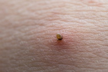 İnsan derisiüzerinde kene Makro fotoğraf emme. Ixodes ricinus. Pembe tahriş olmuş epidermisin içine ısırılan şişmiş parazit. Küçük kırmızı damlalar. Tehlikeli böcek akarı. Ensefalit, Lyme hastalığı enfeksiyonu.