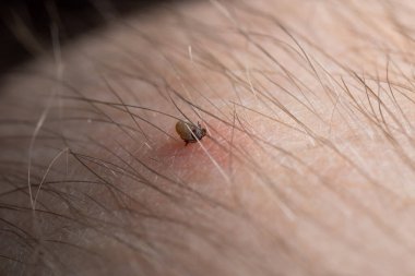 Sucking a tick Macro photo on human skin. Ixodes ricinus. The swollen parasite has bitten the irritated pink epidermis. Small red drops. Dangerous insect mite. Encephalitis, Lyme disease infection.