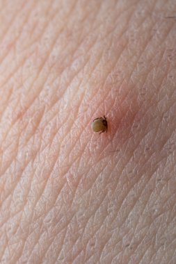 İnsan derisiüzerinde kene Makro fotoğraf emme. Ixodes ricinus. Pembe tahriş olmuş epidermisin içine ısırılan şişmiş parazit. Küçük kırmızı damlalar. Tehlikeli böcek akarı. Ensefalit, Lyme hastalığı enfeksiyonu.
