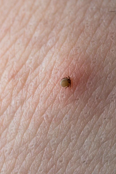 Chupando Carrapato Macro Foto Pele Humana Ixodes Ricinus Parasita Inchado — Fotografia de Stock