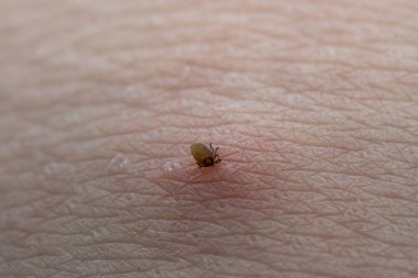 İnsan derisiüzerinde kene Makro fotoğraf emme. Ixodes ricinus. Pembe tahriş olmuş epidermisin içine ısırılan şişmiş parazit. Küçük kırmızı damlalar. Tehlikeli böcek akarı. Ensefalit, Lyme hastalığı enfeksiyonu.