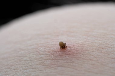 İnsan derisiüzerinde kene Makro fotoğraf emme. Ixodes ricinus. Pembe tahriş olmuş epidermisin içine ısırılan şişmiş parazit. Küçük kırmızı damlalar. Tehlikeli böcek akarı. Ensefalit, Lyme hastalığı enfeksiyonu.