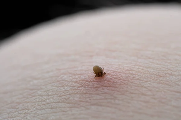 Ssanie Kleszcze Makro Zdjęcie Ludzkiej Skórze Ixodes Ricinus Nadęty Pasożyta — Zdjęcie stockowe