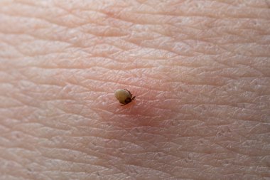 İnsan derisiüzerinde kene Makro fotoğraf emme. Ixodes ricinus. Pembe tahriş olmuş epidermisin içine ısırılan şişmiş parazit. Küçük kırmızı damlalar. Tehlikeli böcek akarı. Ensefalit, Lyme hastalığı enfeksiyonu.