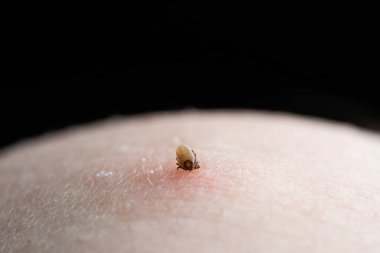 İnsan derisiüzerinde kene Makro fotoğraf emme. Ixodes ricinus. Pembe tahriş olmuş epidermisin içine ısırılan şişmiş parazit. Küçük kırmızı damlalar. Tehlikeli böcek akarı. Ensefalit, Lyme hastalığı enfeksiyonu.