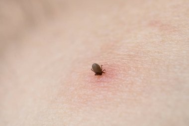 İnsan derisiüzerinde kene Makro fotoğraf emme. Ixodes ricinus. Pembe tahriş olmuş epidermisin içine ısırılan şişmiş parazit. Küçük kırmızı damlalar. Tehlikeli böcek akarı. Ensefalit, Lyme hastalığı enfeksiyonu.