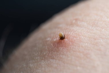 İnsan derisiüzerinde kene Makro fotoğraf emme. Ixodes ricinus. Pembe tahriş olmuş epidermisin içine ısırılan şişmiş parazit. Küçük kırmızı damlalar. Tehlikeli böcek akarı. Ensefalit, Lyme hastalığı enfeksiyonu.