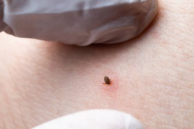 İnsan derisiüzerinde kene Makro fotoğraf emme. Ixodes ricinus. Pembe tahriş olmuş epidermisin içine ısırılan şişmiş parazit. Küçük kırmızı damlalar. Tehlikeli böcek akarı. Ensefalit, Lyme hastalığı enfeksiyonu.