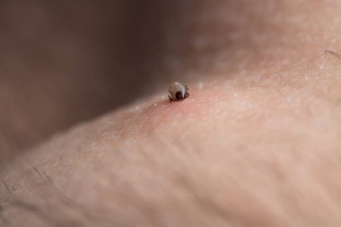 İnsan derisiüzerinde kene Makro fotoğraf emme. Ixodes ricinus. Pembe tahriş olmuş epidermisin içine ısırılan şişmiş parazit. Küçük kırmızı damlalar. Tehlikeli böcek akarı. Ensefalit, Lyme hastalığı enfeksiyonu.
