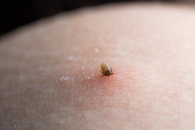 İnsan derisiüzerinde kene Makro fotoğraf emme. Ixodes ricinus. Pembe tahriş olmuş epidermisin içine ısırılan şişmiş parazit. Küçük kırmızı damlalar. Tehlikeli böcek akarı. Ensefalit, Lyme hastalığı enfeksiyonu.