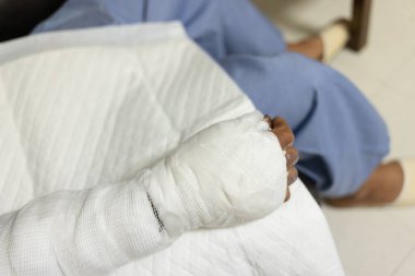 Patient with burns in the hospital. applying bandage onto patient's arm burn wound.