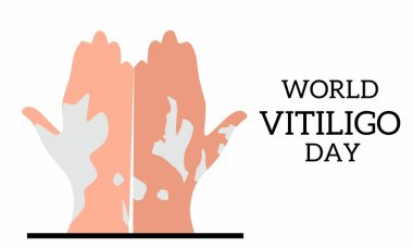 Vektör illüstrasyonu, vitiligodan etkilenen iki el, bir bayrak ya da poster olarak, dünya vitiligo günü.