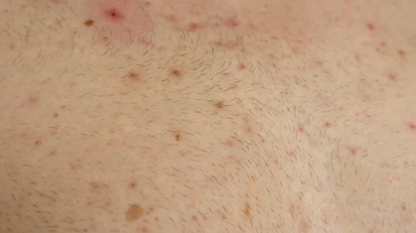 sores and rashes where monkeypox occurs to the skin