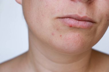 close up natural woman bad acne skin with scars