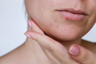 close up natural woman bad acne skin with scars