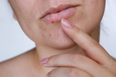 close up natural woman bad acne skin with scars