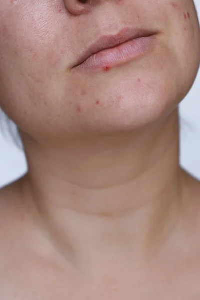 Close Natural Woman Bad Acne Skin Scars — Stockfoto