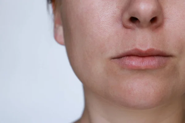 Close Γυναίκα Πρόσωπο Δέρμα Μετά Την Ακμή — Φωτογραφία Αρχείου