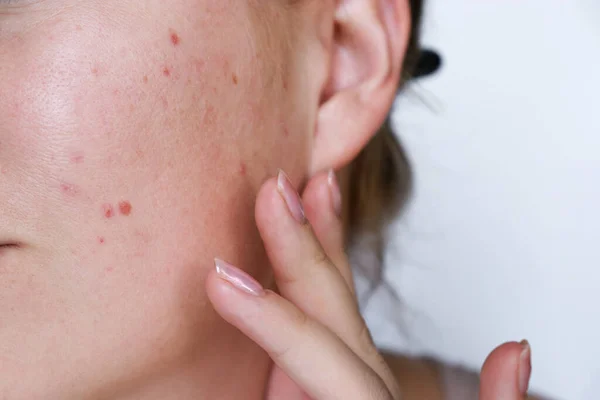 Close Natural Woman Bad Acne Skin Scars — Fotografia de Stock