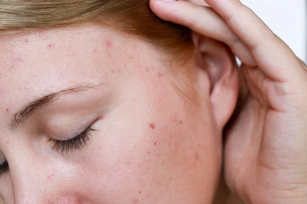 Close Natural Woman Bad Acne Skin Scars — Stock fotografie