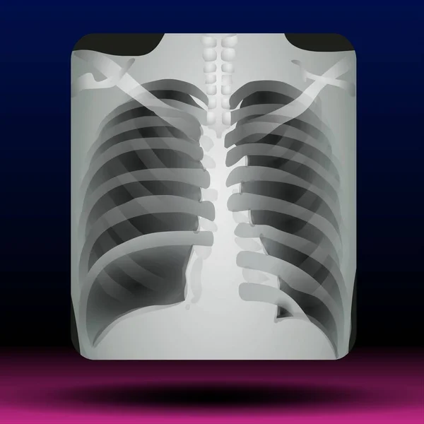 Fla - source file available - Illustration of X-ray of a human chest