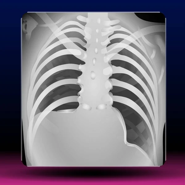 Fla - source file available - Xray medical image of chest - Illustration of medical xray picture of chest patient