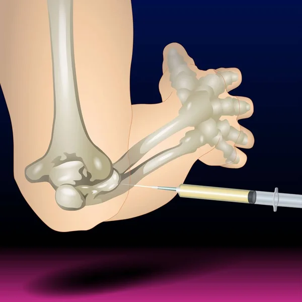 Fla source file Available - Elbow Bone Illustration - Syringe, Injection