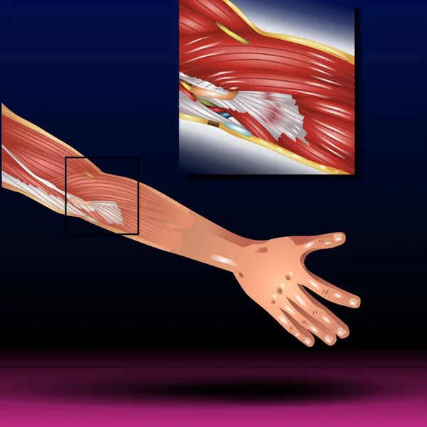 Fla - source file available - Elbow Tendonitis