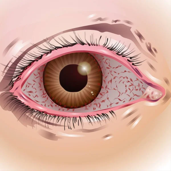 Fla source file available - Your eyes are organs that allow you to see. Many parts of your eye work together to bring objects into focus and send visual information to your brain. Several conditions and injures can cause changes in eyesight.