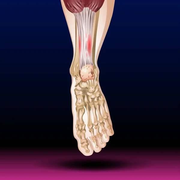 Fla source file available - The leg from the knee to the ankle is called the crus. The calf is the back portion, and the tibia or shinbone together with the smaller fibula make up the front of the lower leg.