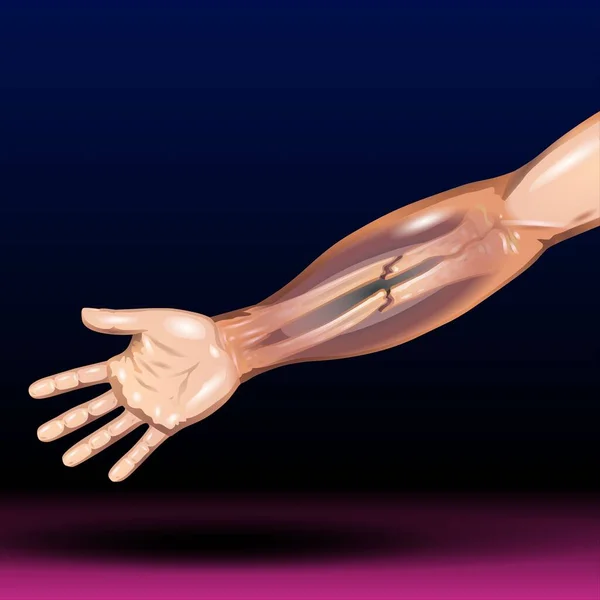 Fla source file available - the arm proper; two thinner bones, the radius and ulna, in the forearm; and sets of carpal and metacarpal bones in the hand and digits in the fingers.