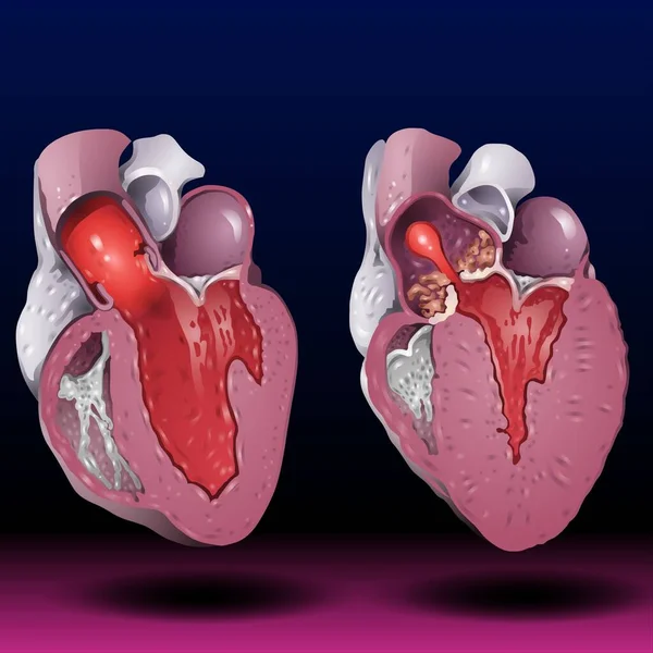 Fla source file available - The heart is a muscular organ about the size of a fist, located just behind and slightly left of the breastbone.