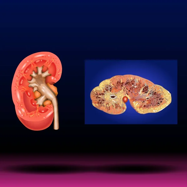 Fla - source file available - healthy kidney, recovery of kidney functions, Urology or nephrology medical banner